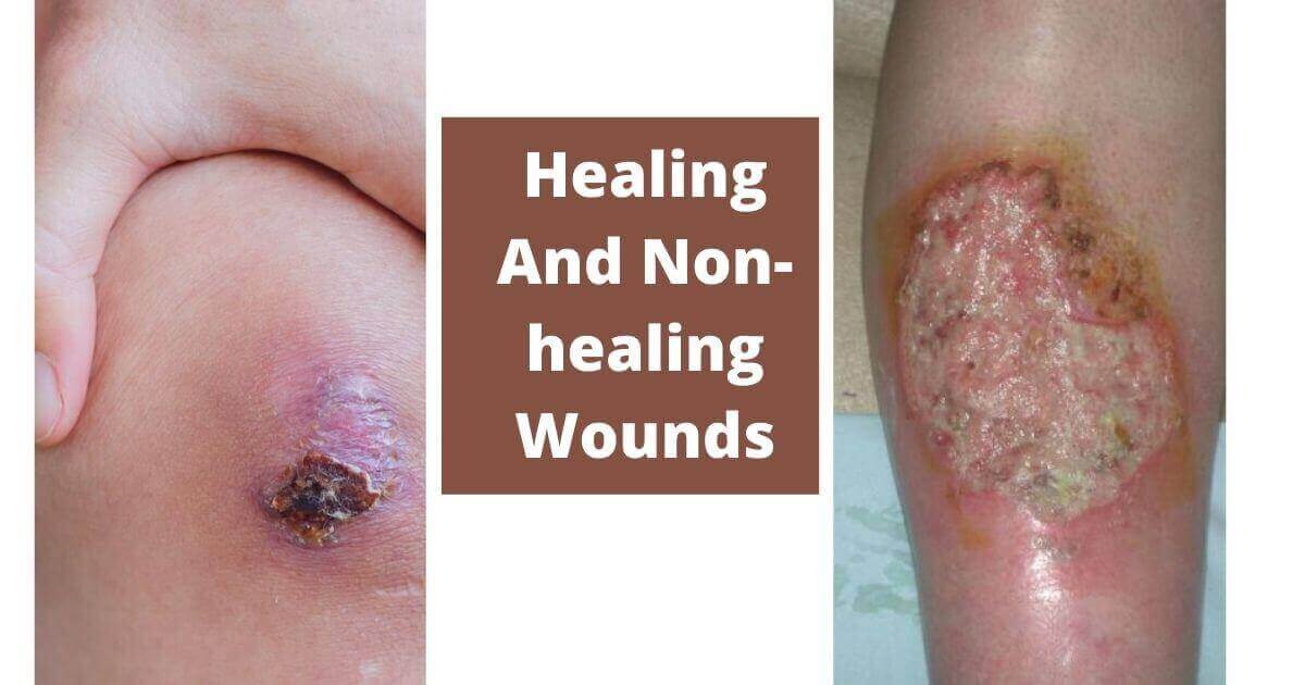 Signs of Healing And Non-healing Wounds